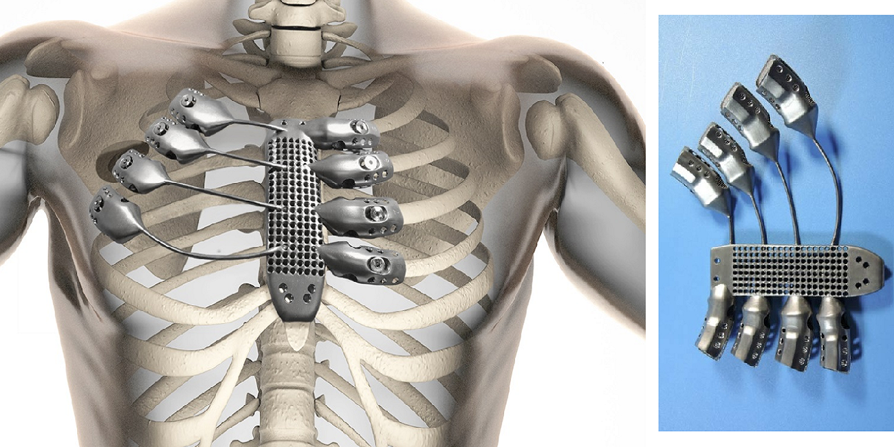 3D Printing Gives Cancer Patient New Ribs and Sternum in First-of-Its-Kind Surgery - 3DPrint.com | Additive Manufacturing Business