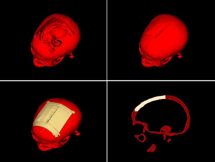 Austrian researchers release free automated design software to produce 3D printable cranial implants - 3D Printing Industry