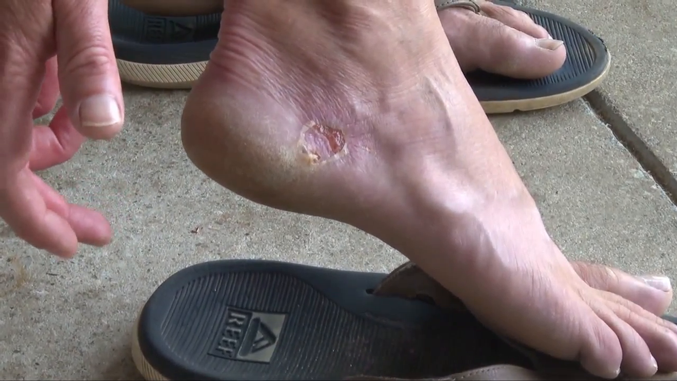 Man contracted a flesh-eating bacteria after walking on Lowcountry beach