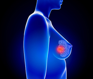 Elinzanetant for Vasomotor Symptoms From Endocrine Therapy for Breast Cancer - The ASCO Post