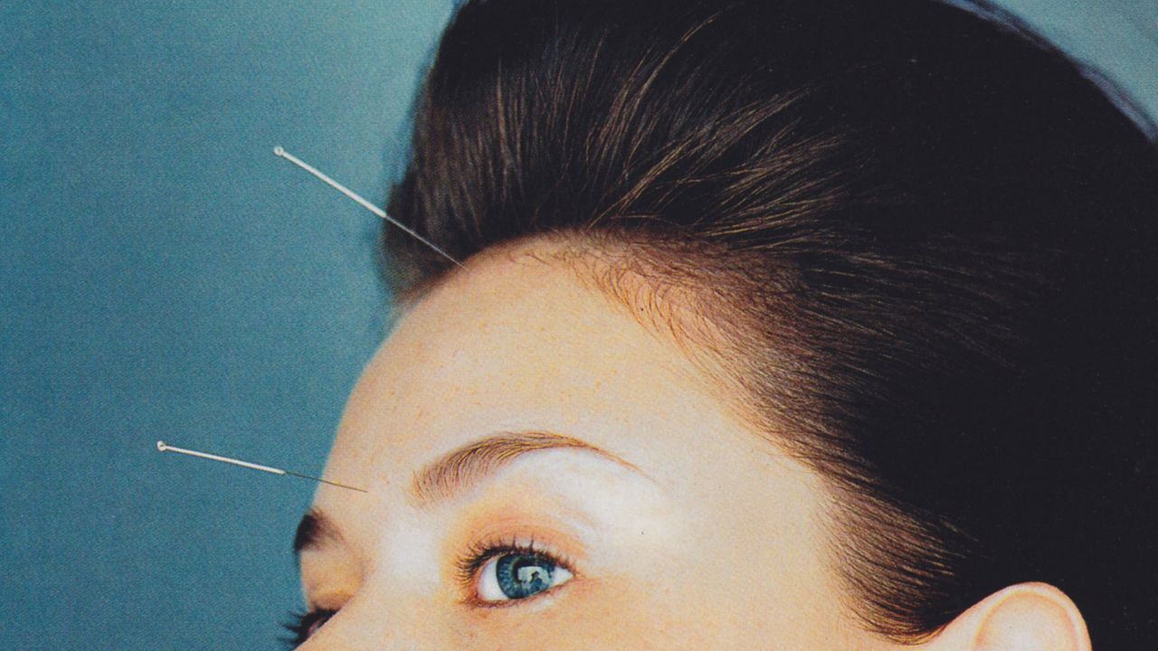 5 Beauty Benefits of Acupuncture | Vogue