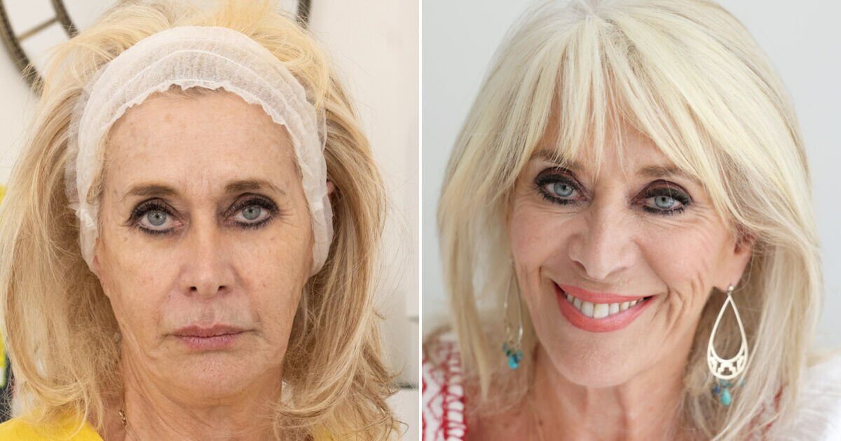 I lost 4 stone on Ozempic – but it caused one problem with my face | Express.co.uk