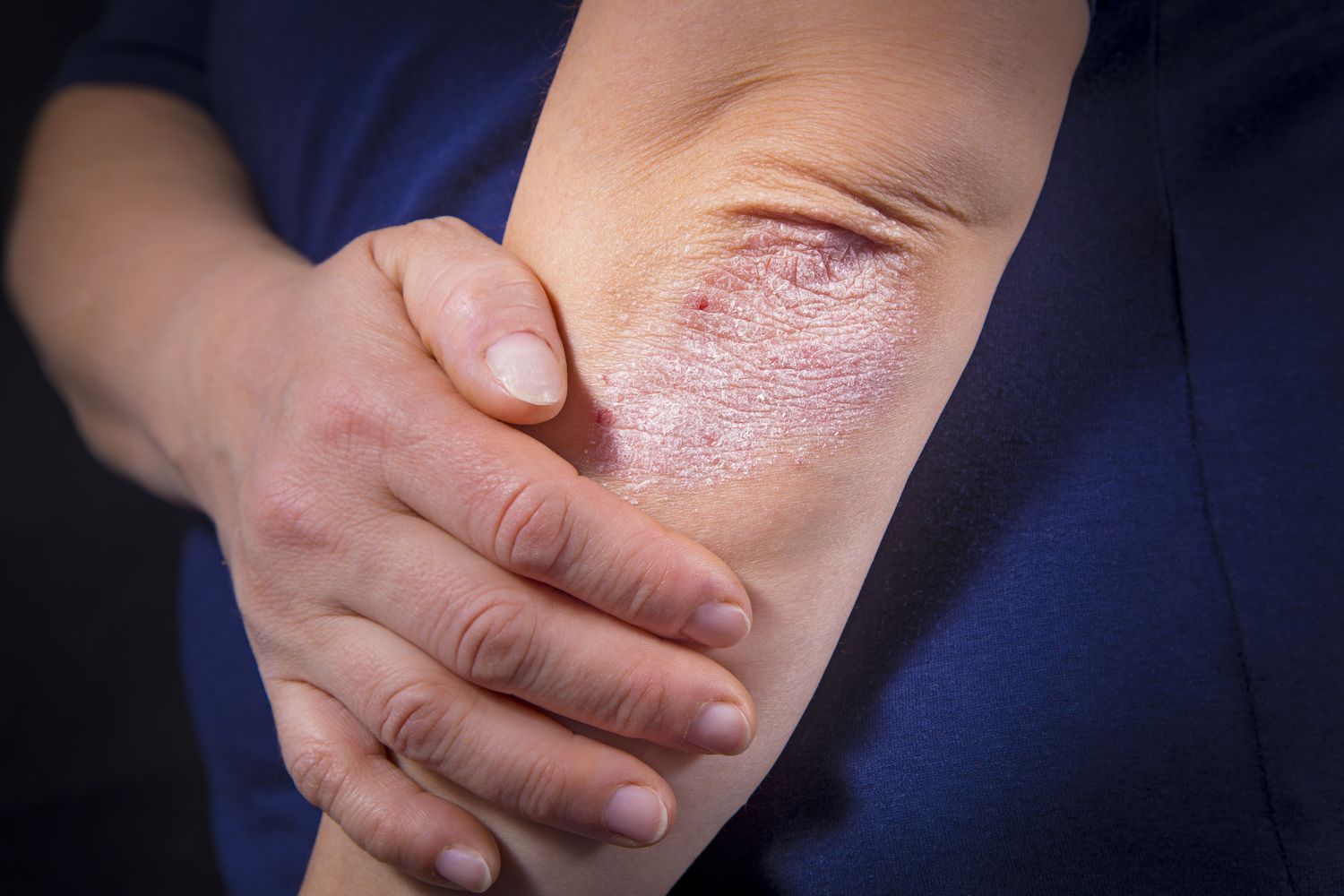 What Is Psoriasis? | Live Science