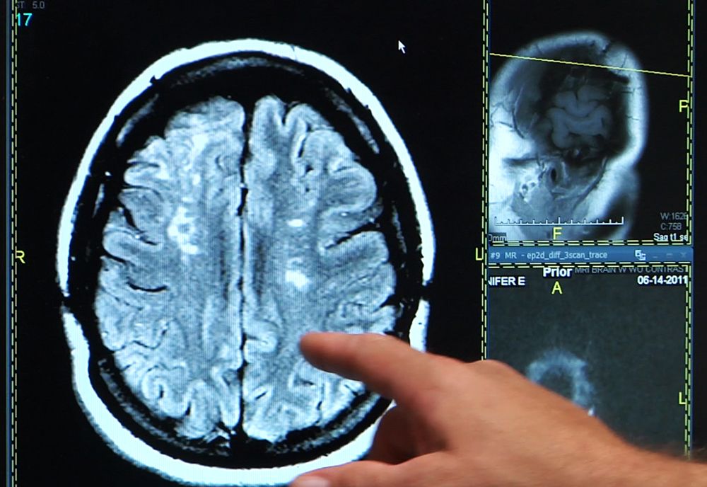 Young Adults Ignore Stroke Symptoms That Could Save Their Lives | Live Science