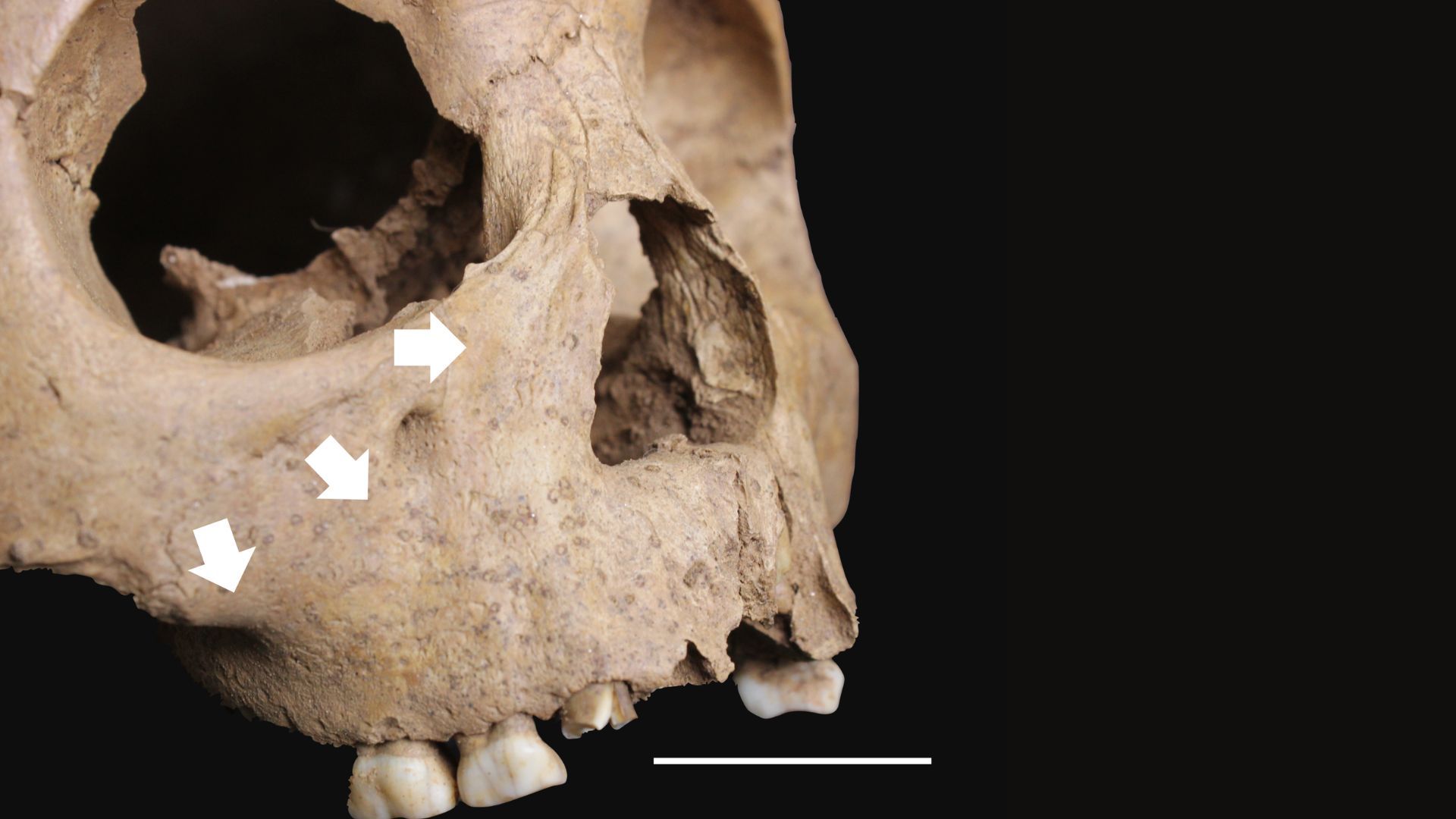 The remains of children from ancient Vietnam may challenge theories about origin of syphilis | Live Science