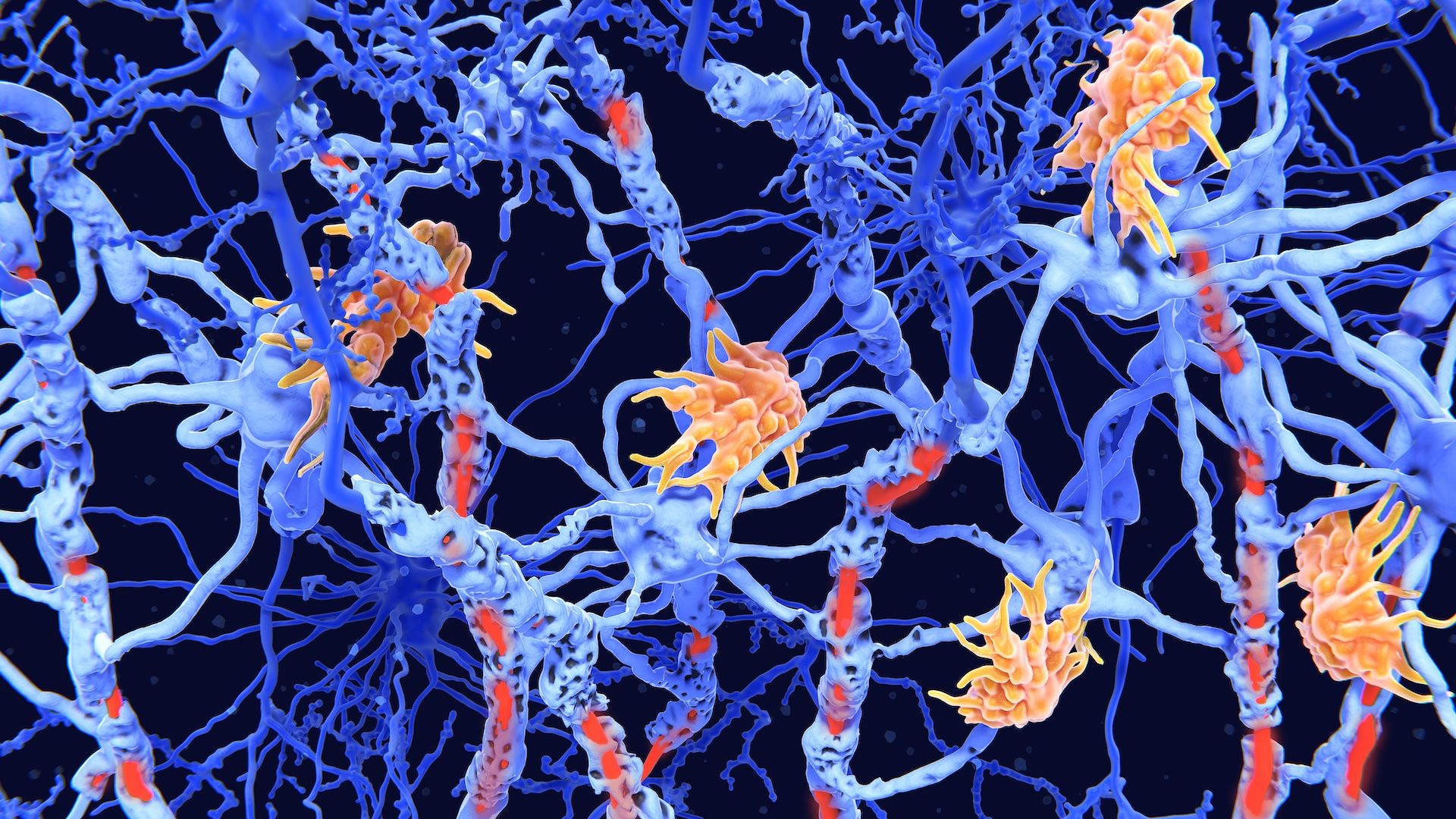 Twin study reveals signs of MS that might be detectable before symptoms | Live Science