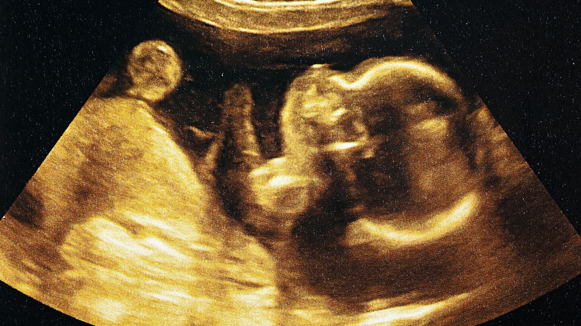 Deadly motor-neuron disease treated in the womb in world 1st | Live Science