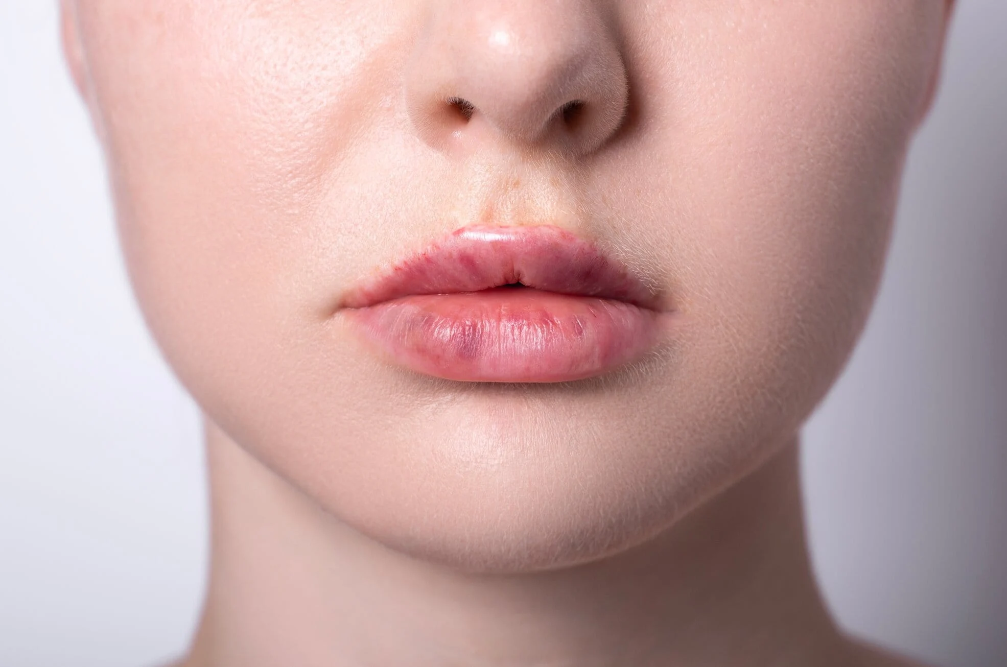 Lip Filler Migration: Clear Answers and Safe Treatment Options