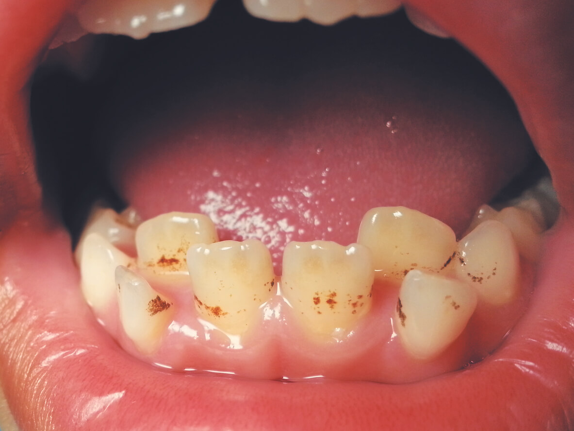 Manchas en los dientes de los niños por suplemento de hierro - Eres Mamá