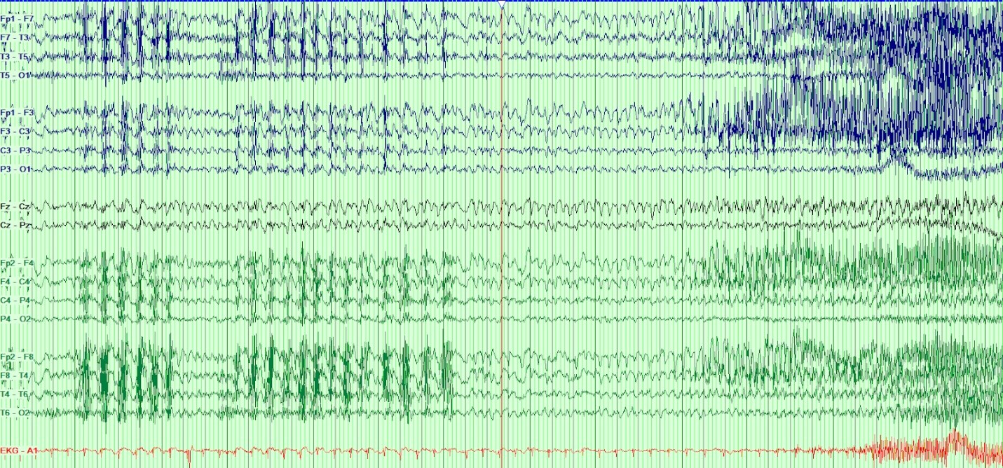 Steroid-Responsive Encephalopathy Associated with Autoimmune Thyroiditis (SREAT) Masquerading as New-Onset Bipolar Disorder in an Elderly Female - eSciPub Journals