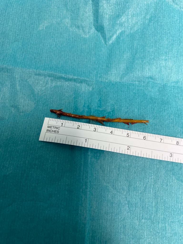 Duodenal and inferior vena cava perforation due to a rosemary branch ingestion: a Case Report - eSciPub Journals