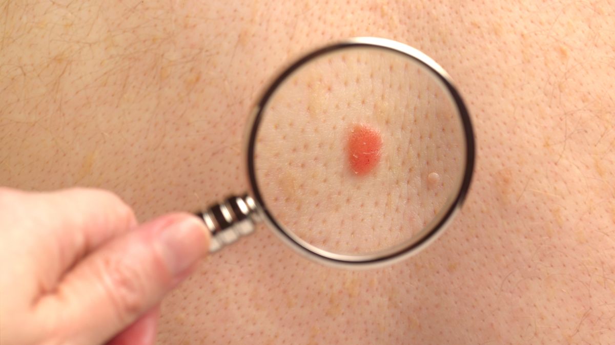 Five early symptoms of skin cancer you MUST go to your doctor over as cases soar - The Mirror