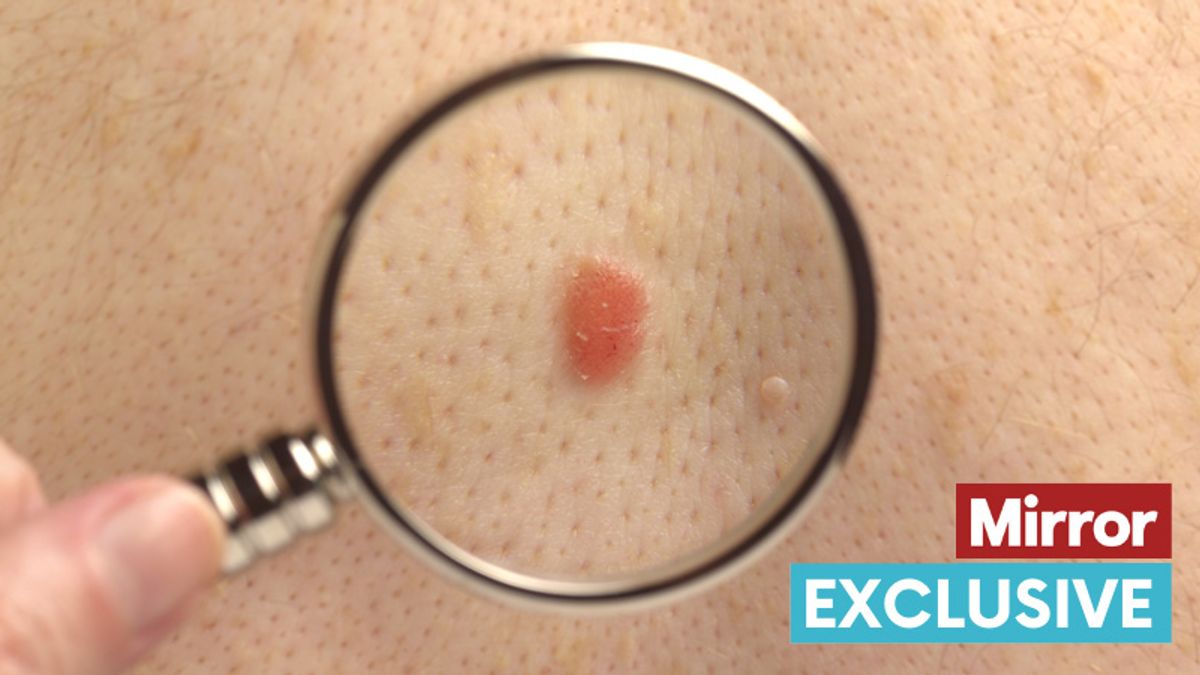Skin cancer breakthrough as AI that spots cases in seconds to be rolled out across NHS - The Mirror