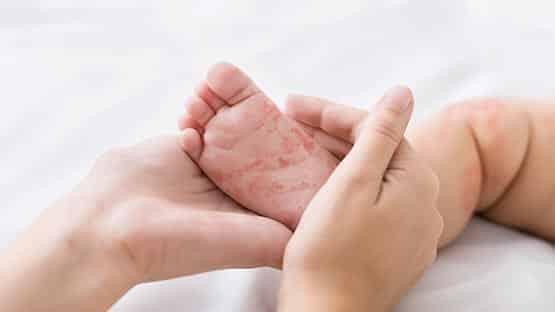 Virginia: No outbreak, but two more cases of measles confirmed in state - NewsBreak