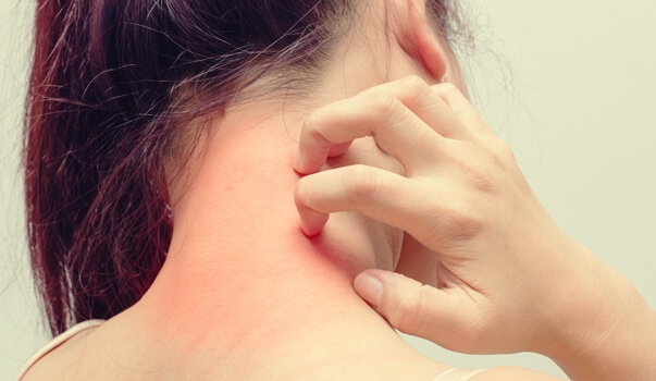 Dermatitis atópica y estrés: ¿cómo se relacionan? - La Mente es Maravillosa