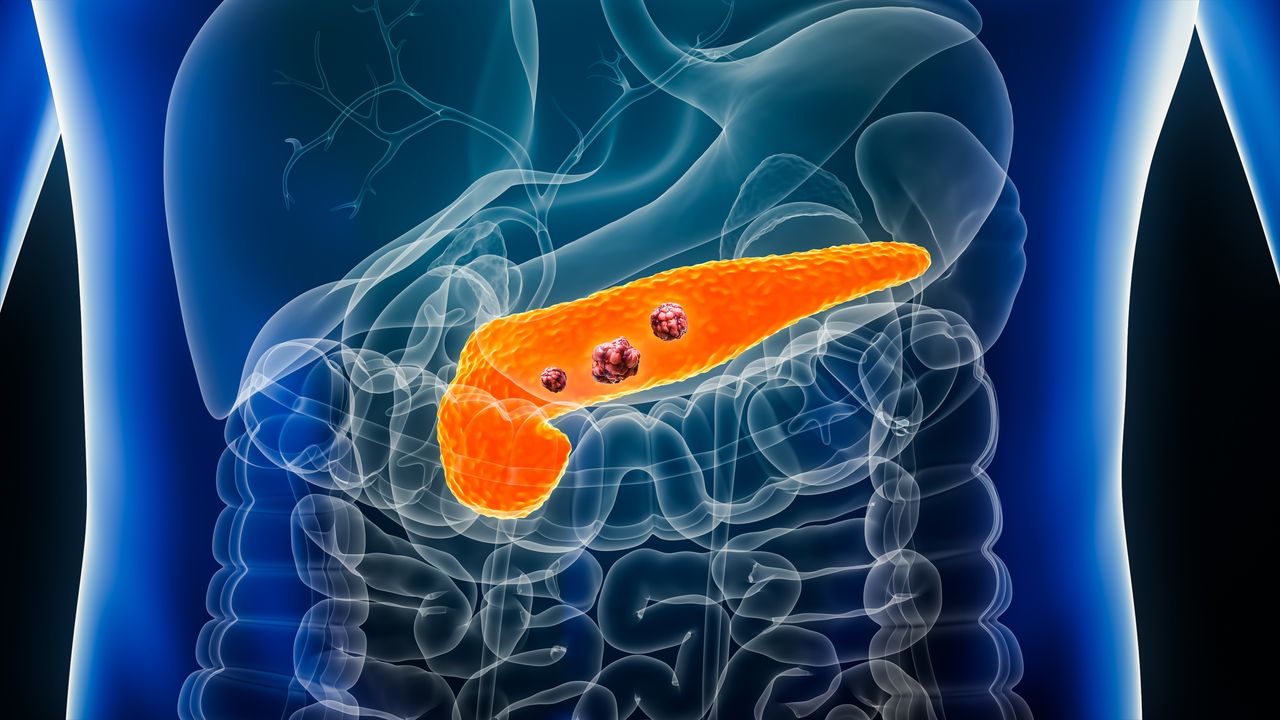 Tumore al pancreas inoperabile: che cosa possiamo aspettarci oggi dalla Ricerca su questo «big killer» | Vanity Fair Italia