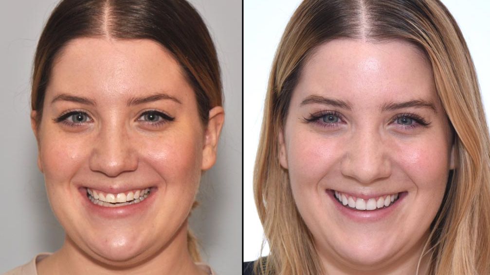 My Veneers Story: See My Dramatic Before and After Photos | Allure
