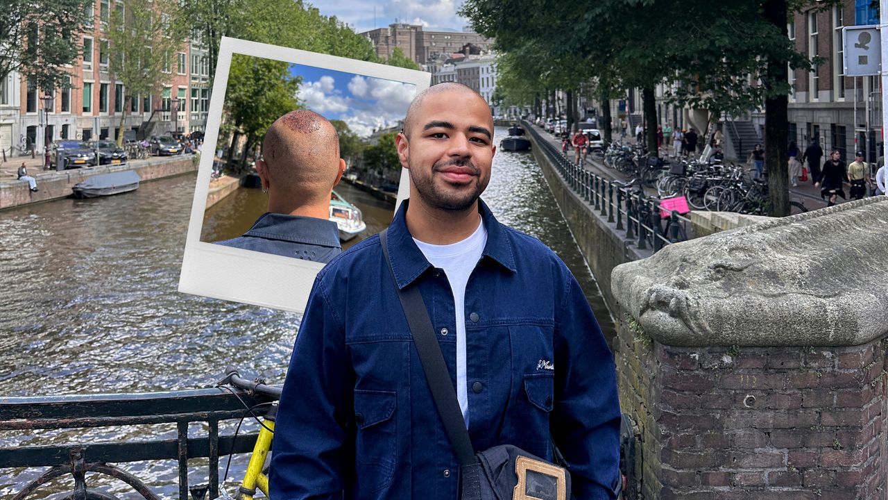 Every Single Thing That Happened During My Hair Transplant | Allure