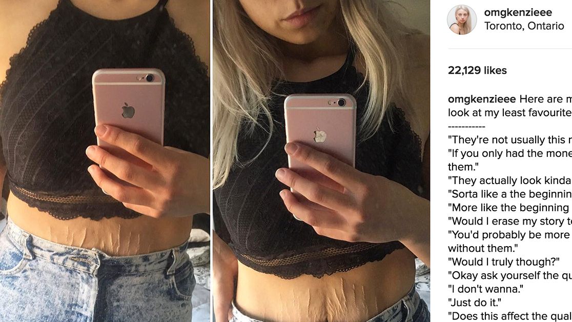 Body-Positive Blogger Kenzie Brenna Just Got Refreshingly Honest About Her Stretch Marks | Glamour