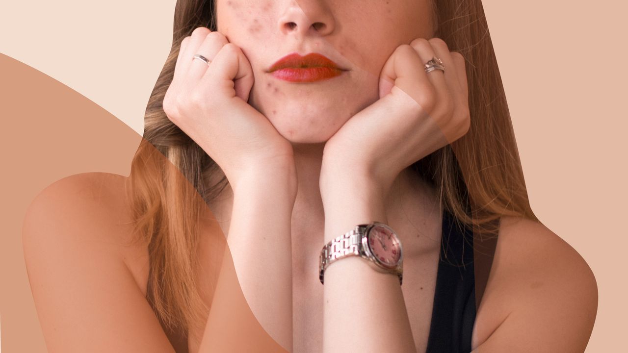Adult Acne Isn’t Just Annoying—It’s Holding Women Back at Work | Glamour