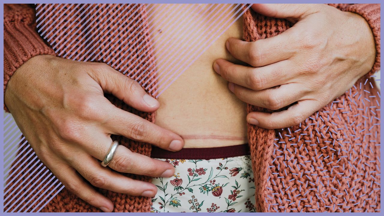 What is a C-Section? Everything You Need to Know About the Procedure | Glamour