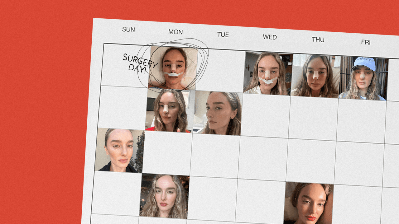 Rhinoplasty Diary: After Years of Daydreaming, I Finally Got a Nose Job at 34 | Glamour