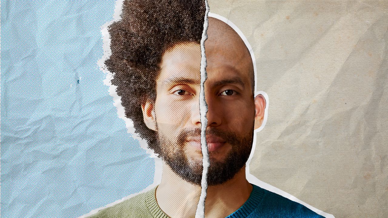 Four Gold-Standard Solutions When You Begin To Bald | GQ