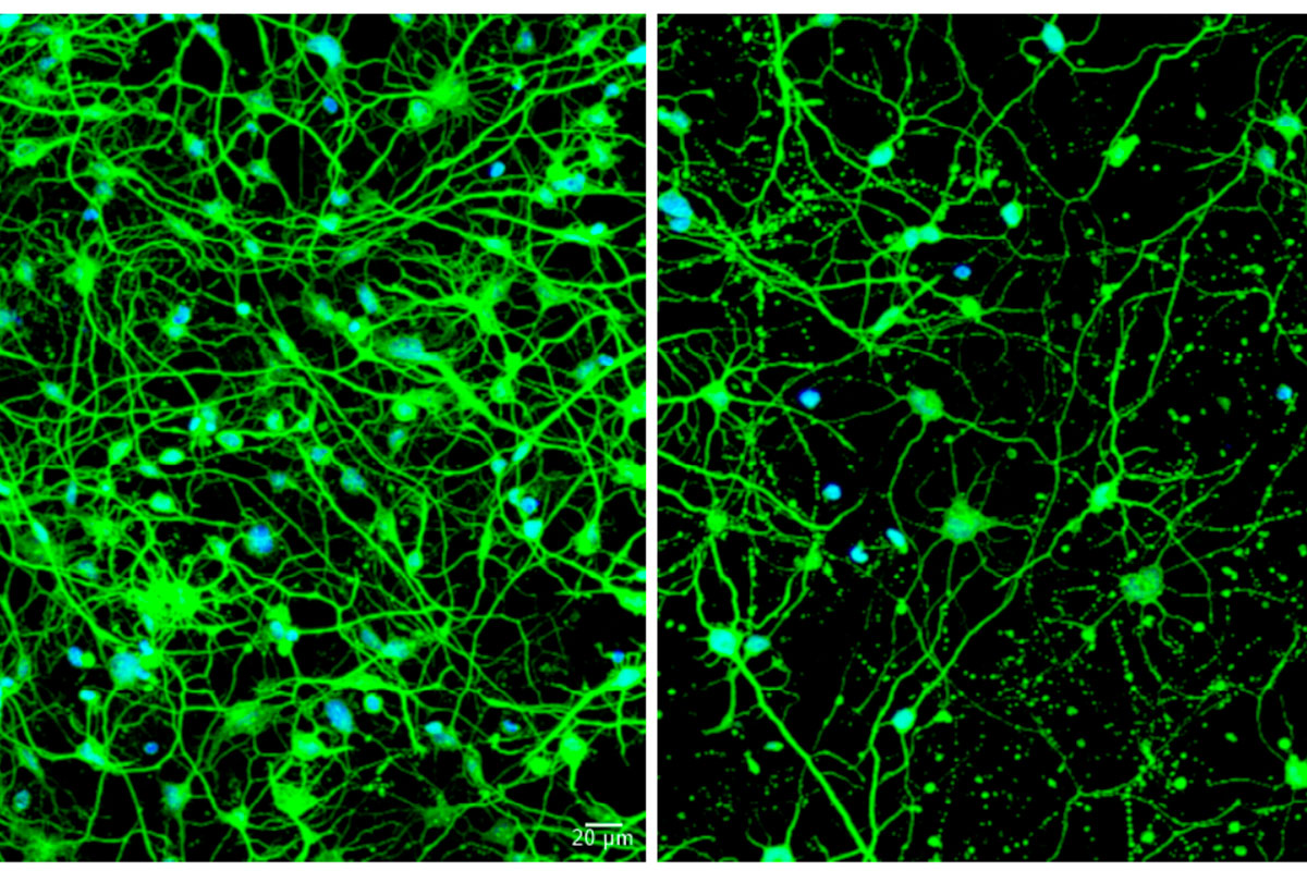 Cellular housekeeping process implicated in fatal neurological disorder – WashU Medicine