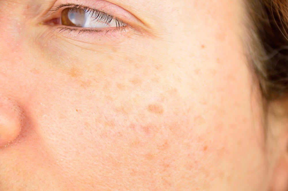 ¿Cómo quitar las manchas en la piel? - Mejor con Salud