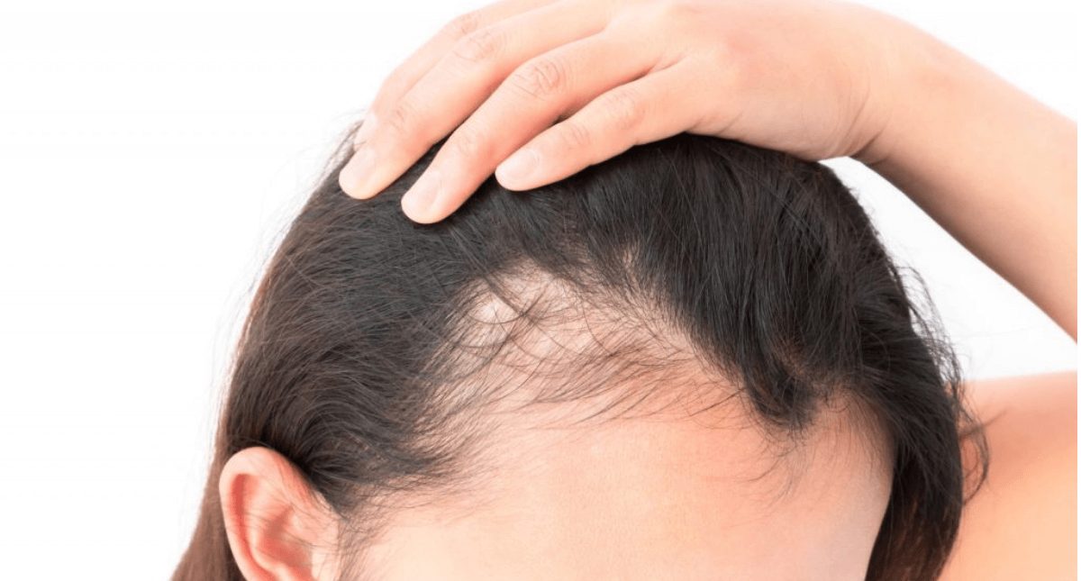 3 mascarillas de levadura para evitar la caída del cabello y acelerar su crecimiento - Mejor con Salud