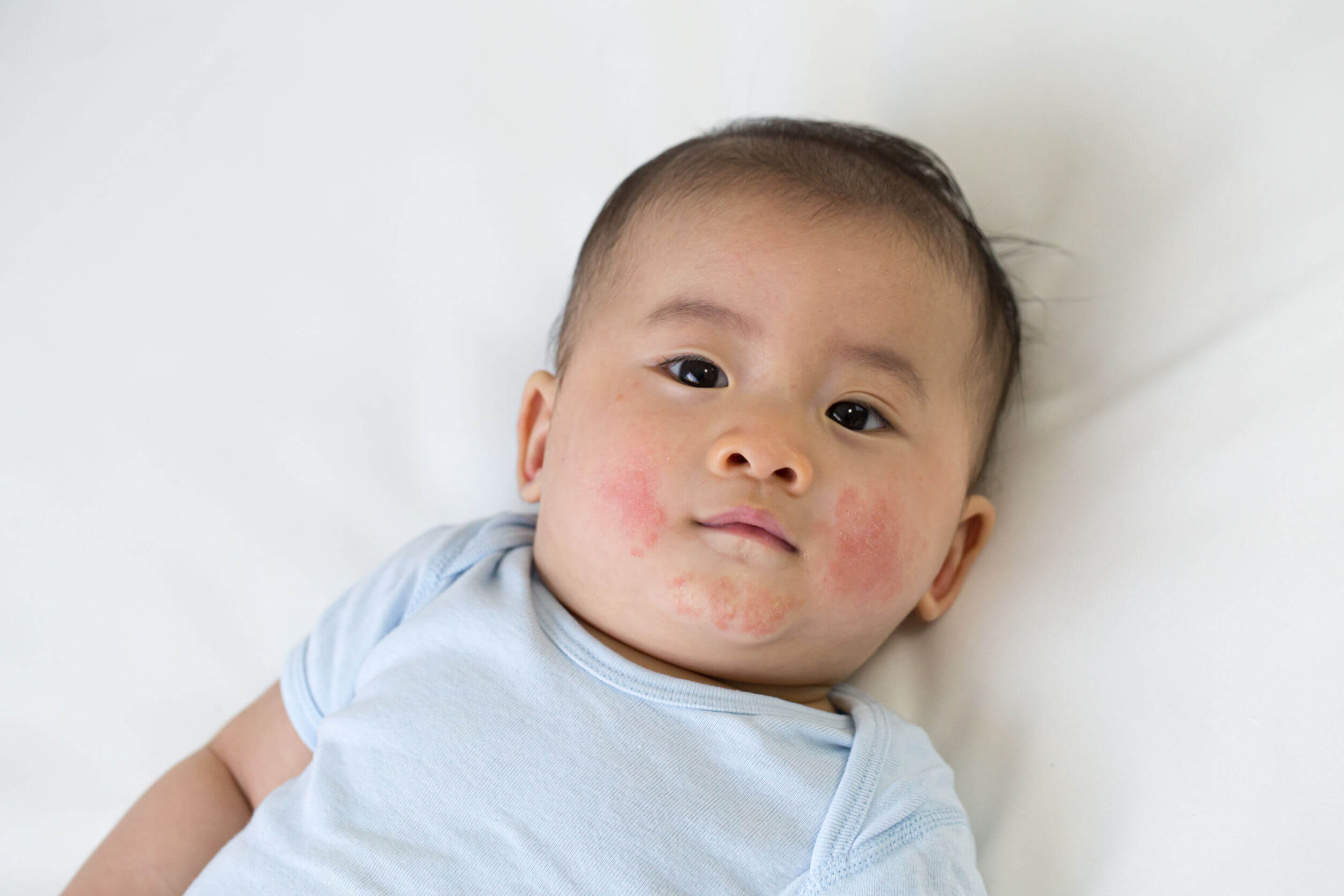 9 alergias más comunes entre los niños - Mejor con Salud