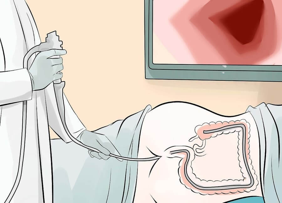 ¿Para qué se practica una colonoscopia? - Mejor con Salud