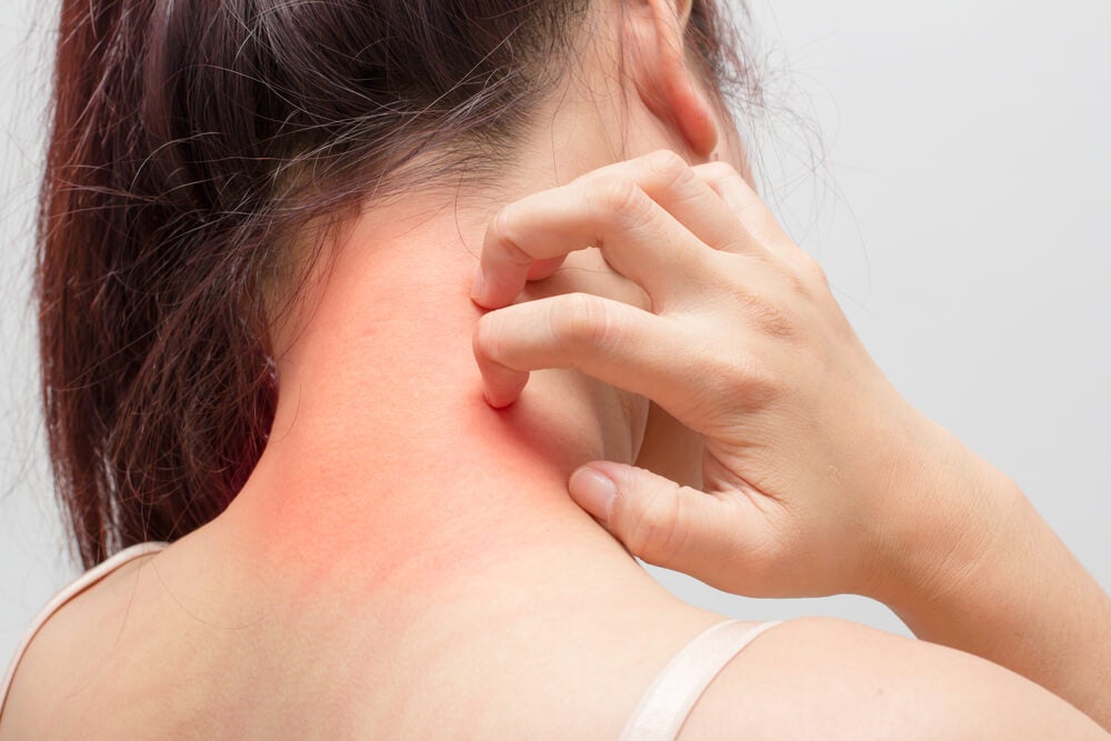 Cómo calmar la alergia de la piel: 3 tratamientos caseros