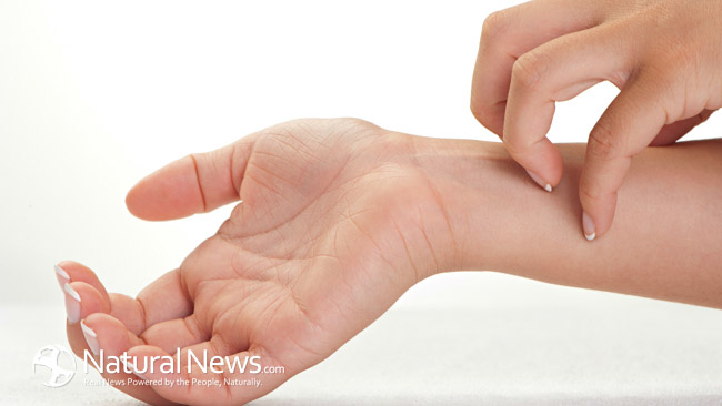 NaturalNewsBlogs Psoriasis-Treatment by Naturopathy