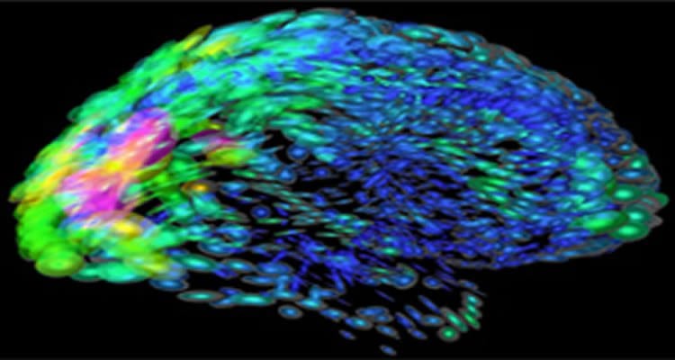 Brain Inflammation A Hallmark Of Autism, Large Scale Analysis Shows - Neuroscience News