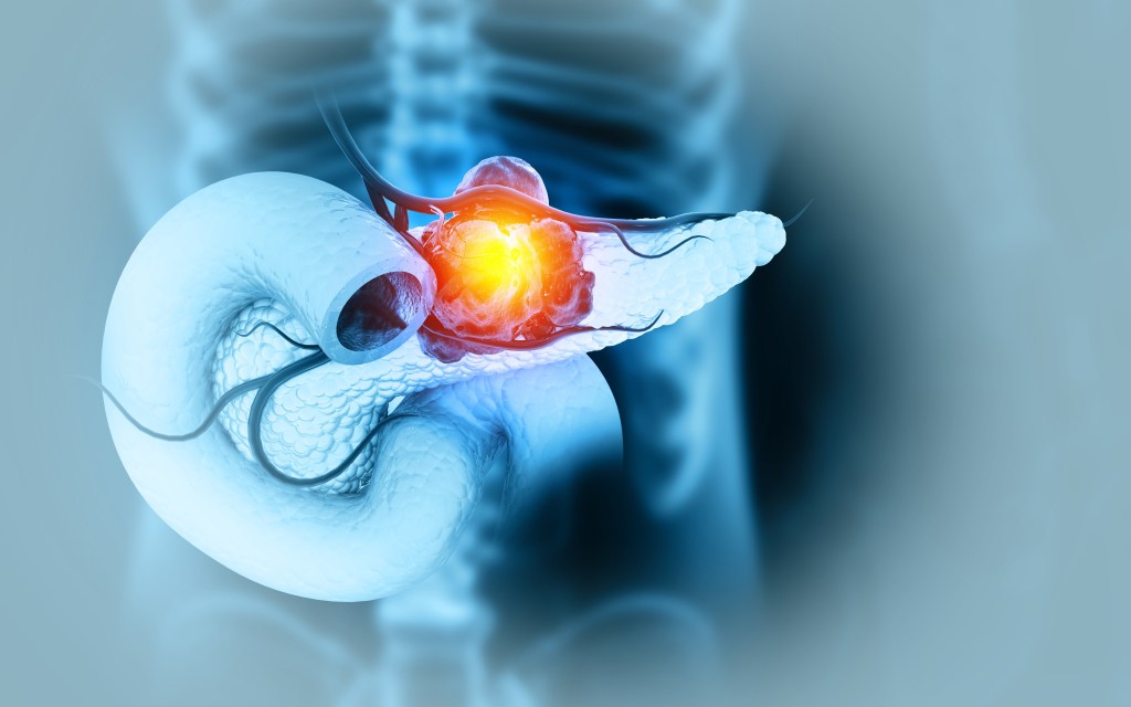 New Clinical Data for Daraxonrasib Sets Stage for Global Phase 3 Trial in Metastatic Pancreatic Cancer - CancerConnect