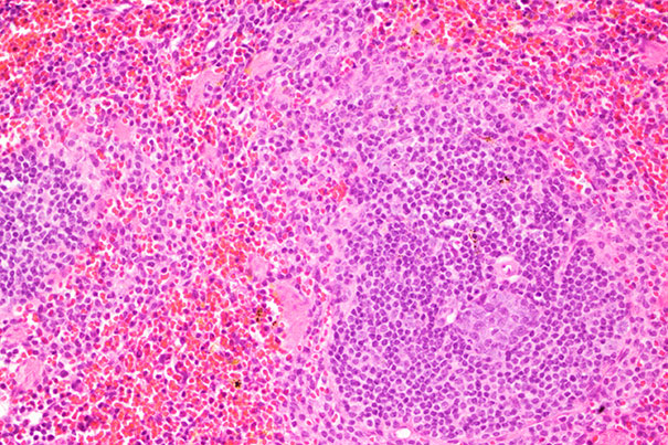 Research suggests new avenues for attacking ALS — Harvard Gazette