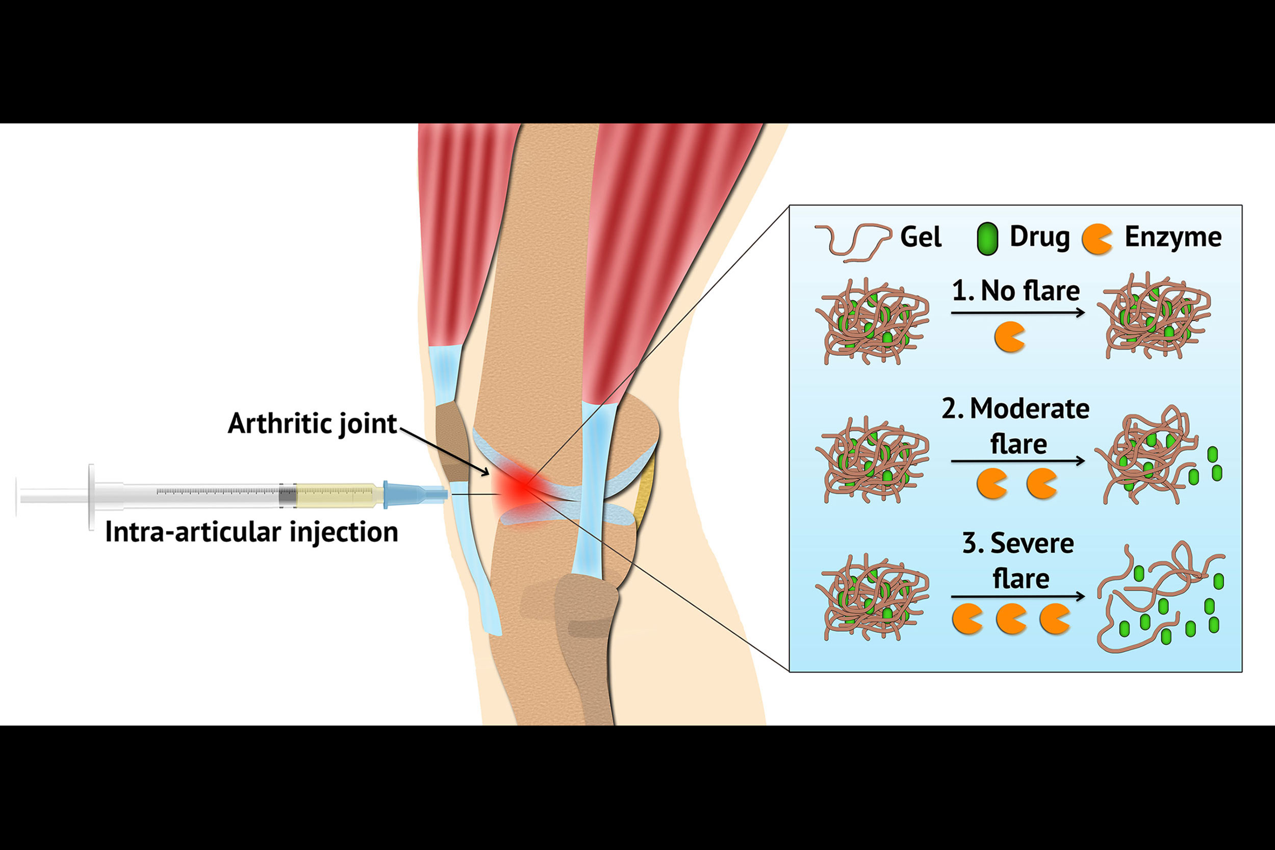 Flare-responsive hydrogel developed to treat arthritis — Harvard Gazette