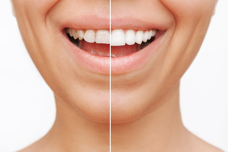 Modern esthetic dentistry ‘restores both confidence and function’ - UT Health San Antonio