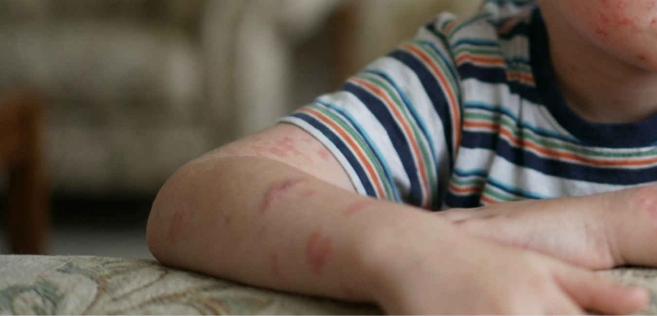 Israel Reports 16th Death in Measles Outbreak as 6-Year-Old Dies