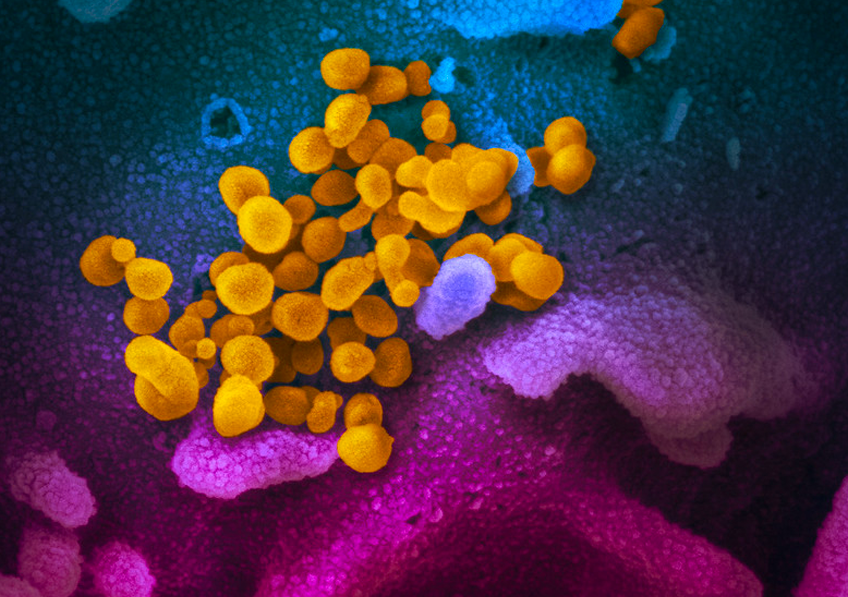 Covid-19 : découverte de marqueurs rénaux et inflammatoires prédictifs de la gravité de la maladie - Salle de presse de l'Inserm