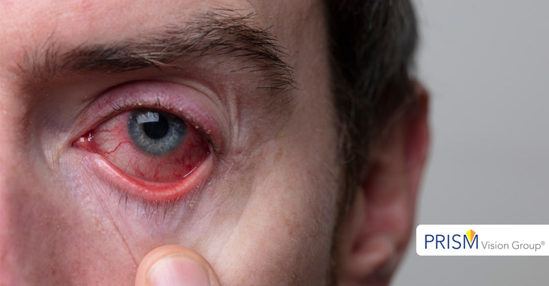 The Dangers of “Redness Relief” Eye Drops | - Eye Associates