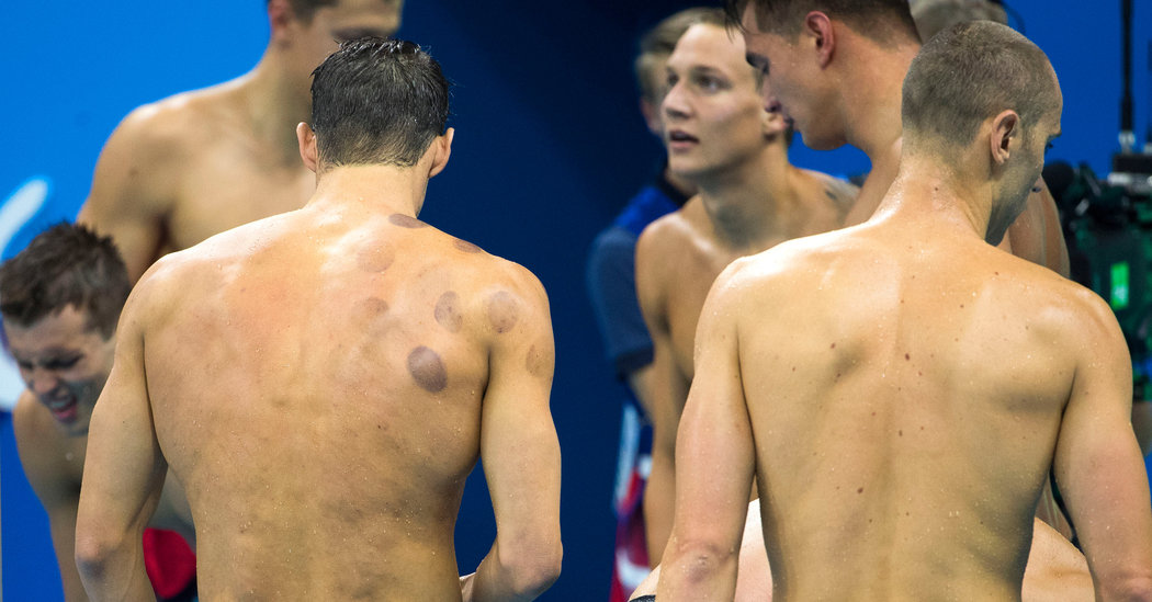 What Are the Purple Dots on Michael Phelps? Cupping Has an Olympic Moment - The New York Times