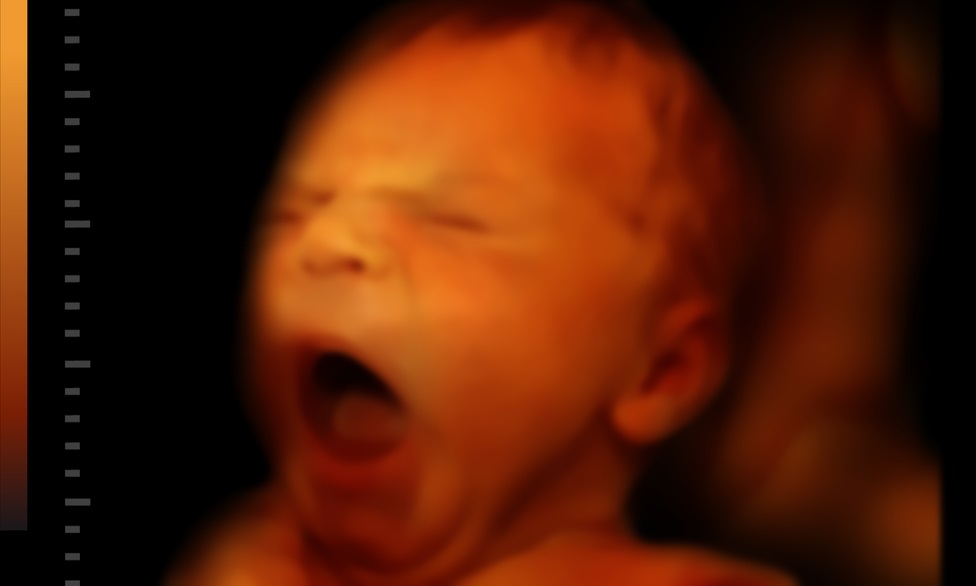 Planned Parenthood’s Legally Free To Traffic Baby Body Parts