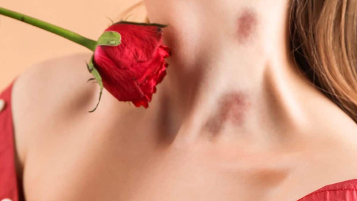 30 Creative Excuses For Hickeys You Can Use When Caught In The Act