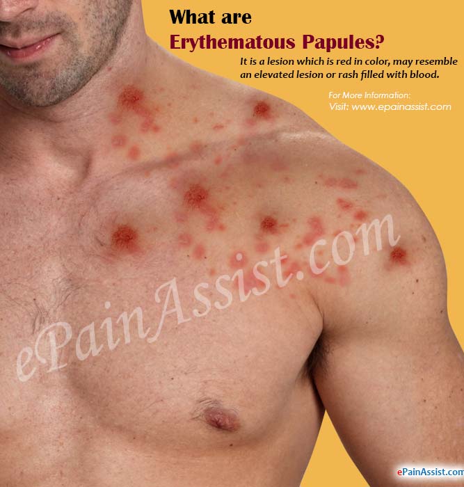 What are Erythematous Papules, Know its Viral Causes, Treatment