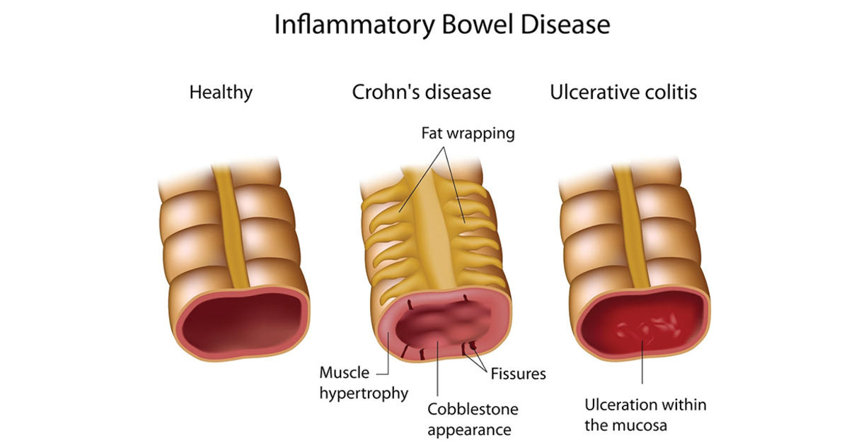 IBD: What is IBD? | IBDrelief