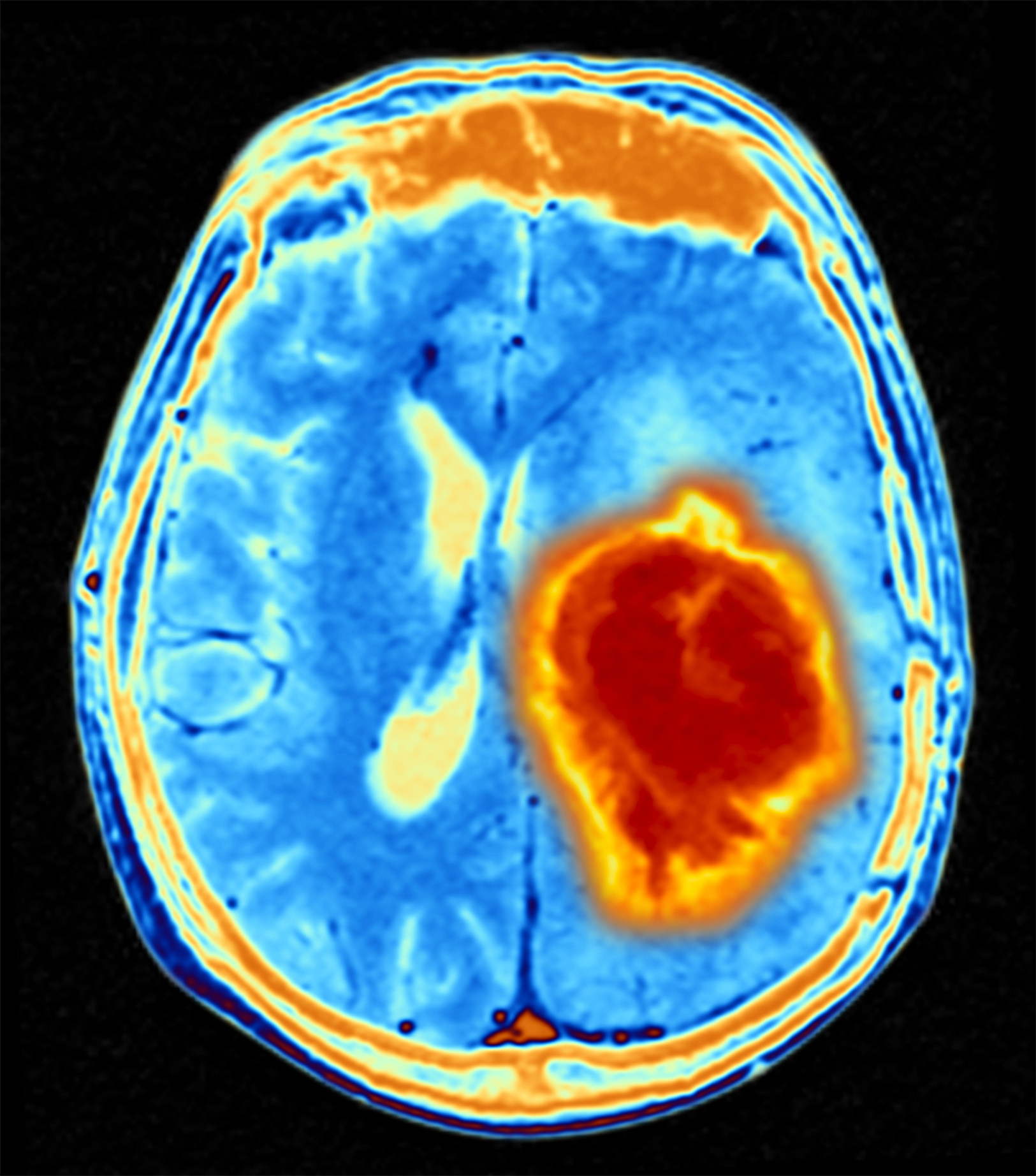 AI Tool Could Revolutionize Brain Image Analysis | Inside Precision Medicine