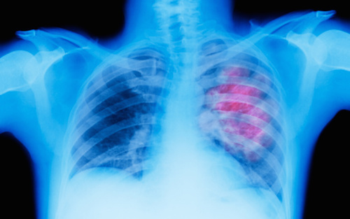 Treating Lung Cancer Patients Earlier in Day Improves Outcomes | Inside Precision Medicine