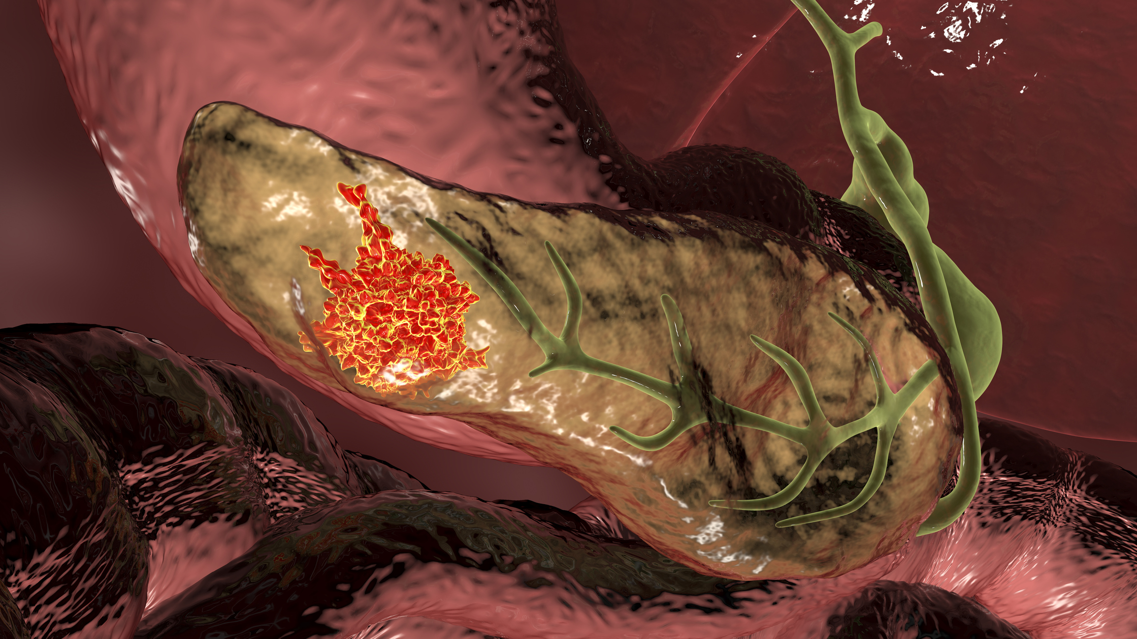 New Blood Test Could Help Detect Pancreatic Cancer Earlier | Inside Precision Medicine